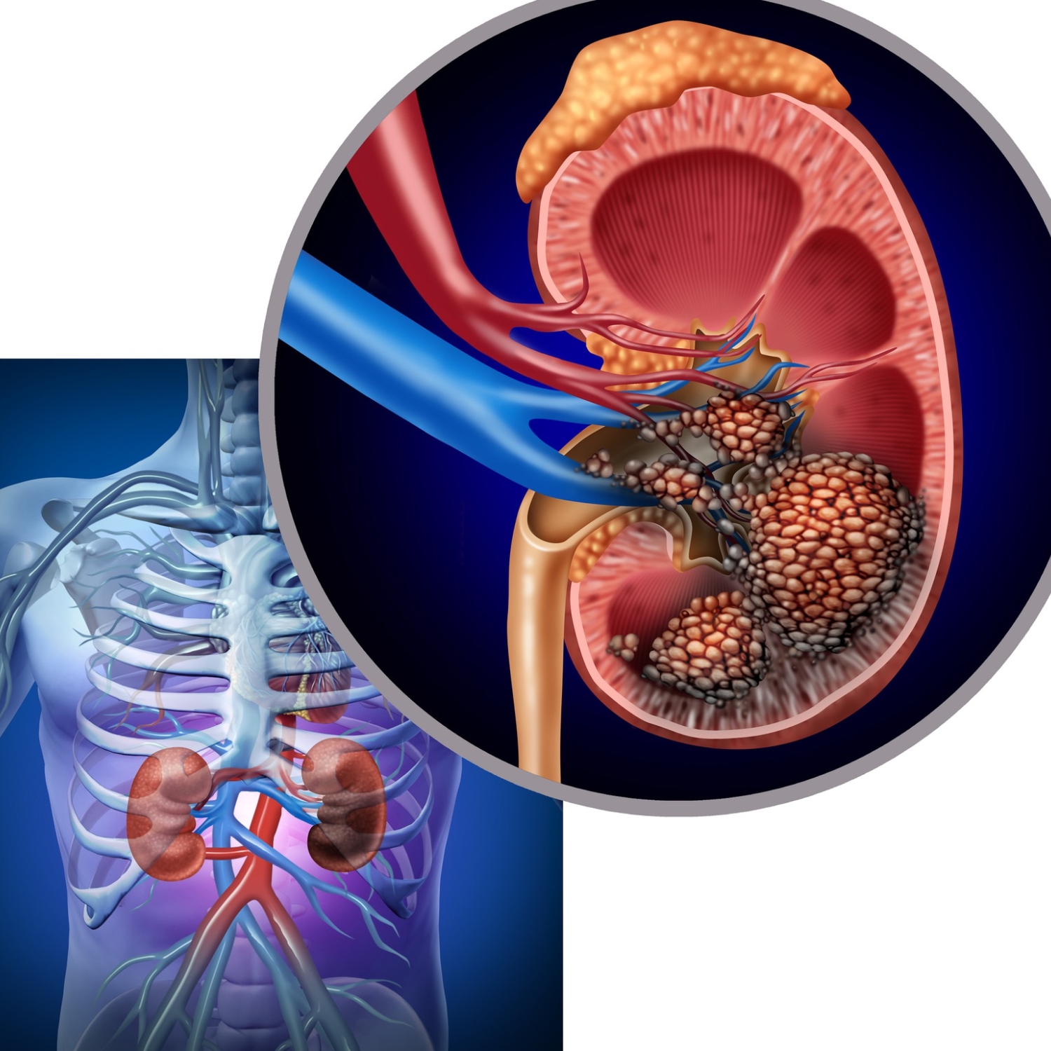 Ayurvedic treatment for  Kidney Cancer